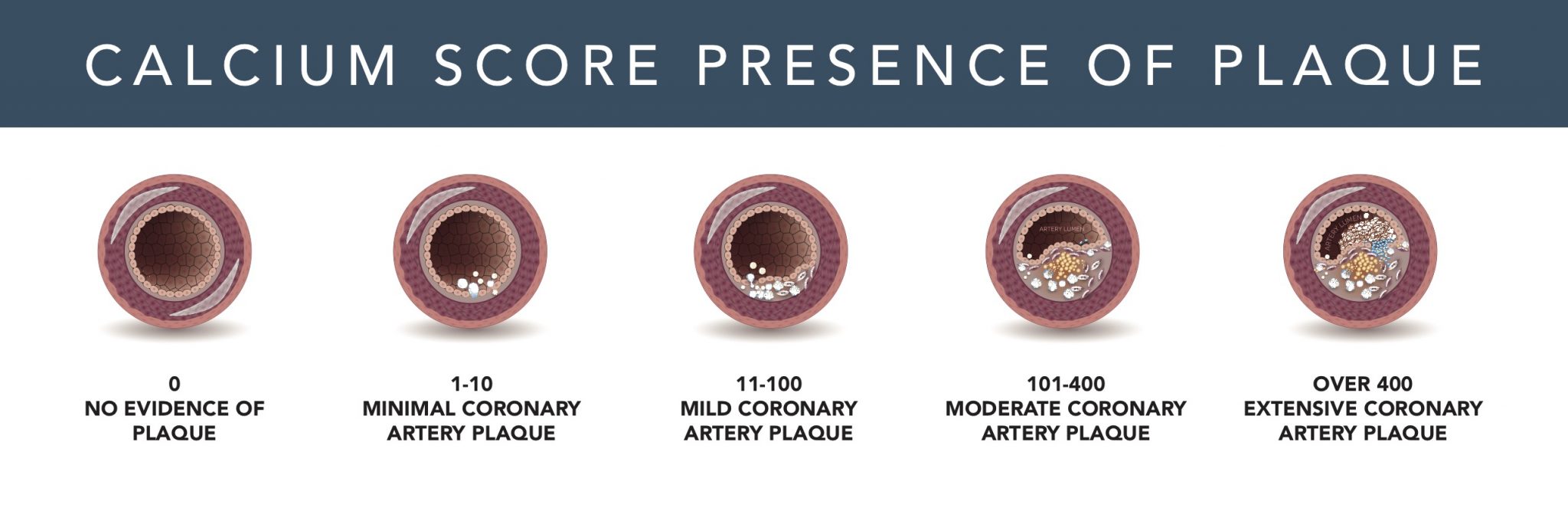 What Causes Calcium Deposits In Coronary Arteries at Travis Gold blog