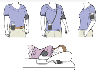 24-hour Ambulatory Blood Pressure (ABP) Monitoring